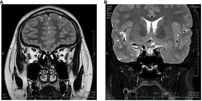 Clinical phenotype of a Kallmann syndrome patient with IL17RD and CPEB4 variants